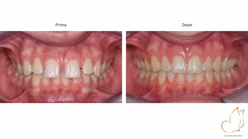 Caso prima e dopo: Denti spaziati